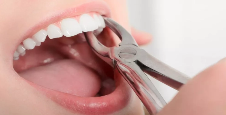 نصائح بعد خلع الضرس الملتهب: خطوات التعافي وتسكين الألم