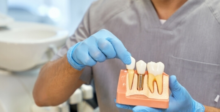 الممنوعات بعد زراعة الأسنان: ما لا يجب فعله لضمان نجاح العملية