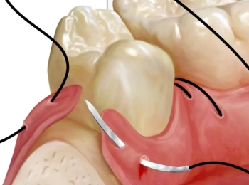 الخياطة بعد زراعة الأسنان: كم تستغرق مدة الالتئام ومتى تزول الغرز؟