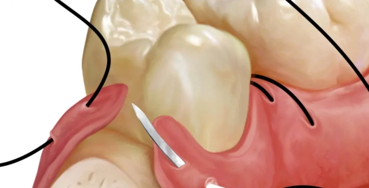 الخياطة بعد زراعة الأسنان: كم تستغرق مدة الالتئام ومتى تزول الغرز؟