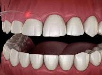 نصائح بعد قص اللثة مع افضل اطباء اسنان في المدينة المنورة