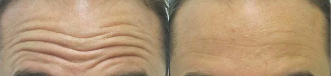 متى تظهر نتائج البوتكس للجبهه ومدى فعاليتها؟