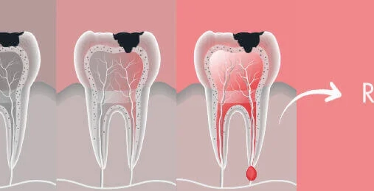 اعرف الفرق بين ألم التسوس وألم العصب