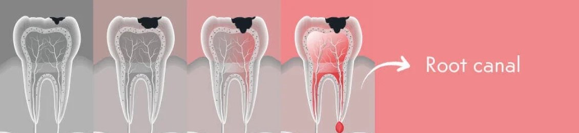 اعرف الفرق بين ألم التسوس وألم العصب