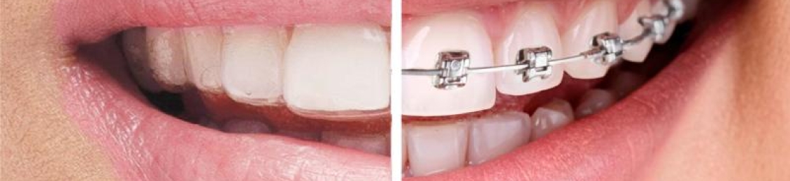 ما هو الفرق بين التقويم الشفاف والمعدني؟