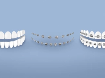 ما الفرق بين التقويم المعدني والسيراميك؟