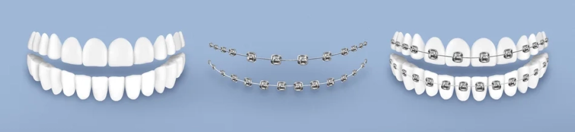 ما الفرق بين التقويم المعدني والسيراميك؟