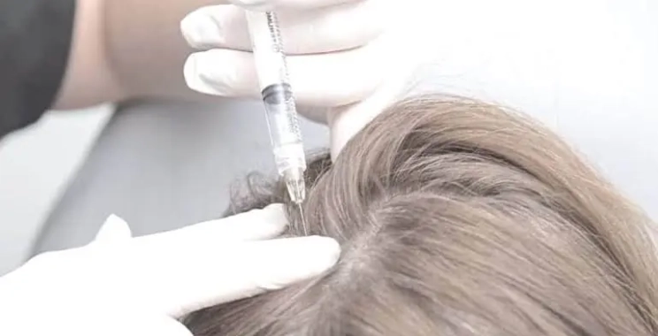 الفرق بين الميزوثيرابي والبلازما لعلاج تساقط الشعر
