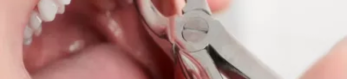 ما هي المدة بين خلع السن والتركيب المناسبة؟