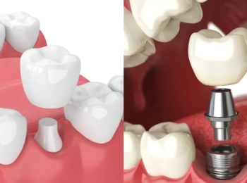 الفرق بين زراعة الاسنان والتركيب في مجمع الطب المتميز