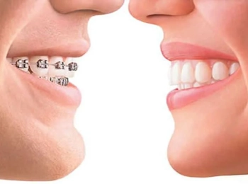 متى تبدأ الأسنان تتحرك بعد التقويم؟ مراحل التعديل خطوة بخطوة