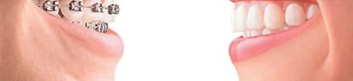 متى تبدأ الأسنان تتحرك بعد التقويم؟ مراحل التعديل خطوة بخطوة