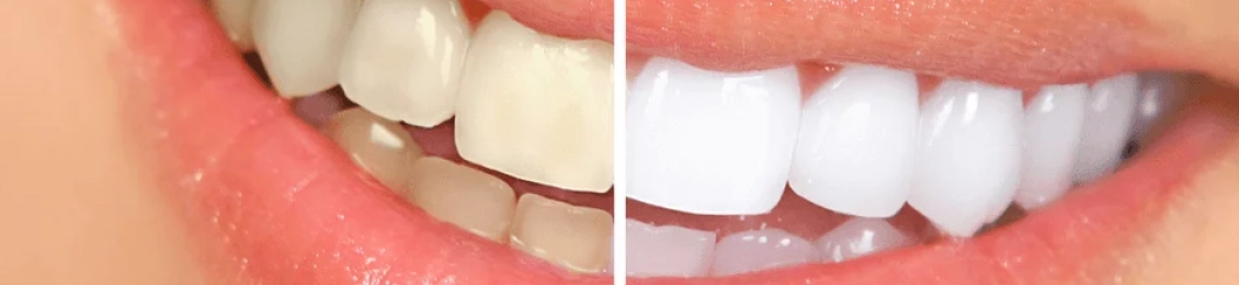 أنواع تبييض الأسنان وافضلها في المدينة المنورة