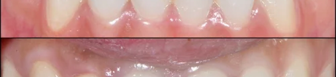 حشو تجميلي قبل وبعد: صور حقيقية ونتائج مذهلة