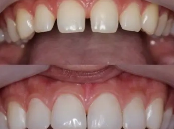 كم سعر حشوة تجميلية للسن الامامي في المدينة المنورة