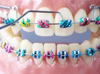 كيف تختار اللون المناسب لتقويم الاسنان حسب شخصيتك ولون بشرتك
