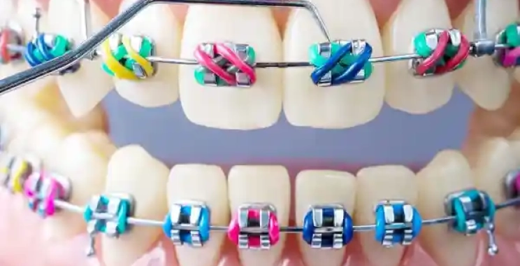 كيف تختار اللون المناسب لتقويم الاسنان حسب شخصيتك ولون بشرتك