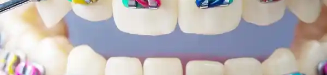 كيف تختار اللون المناسب لتقويم الاسنان حسب شخصيتك ولون بشرتك