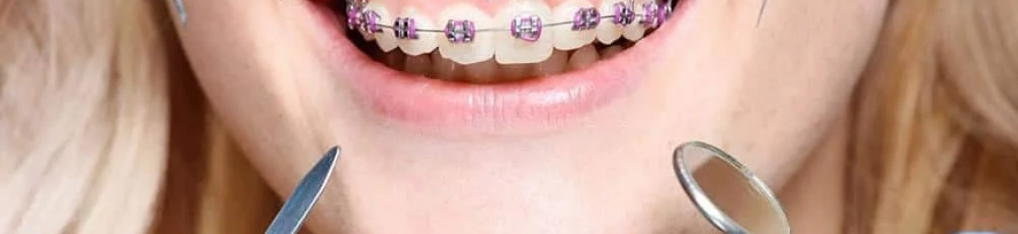 أسعار تركيب تقويم الأسنان في السعودية 2025: الأنواع والتكاليف