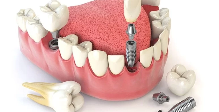 كم تستغرق زراعة الأسنان مع د. محمد بشار