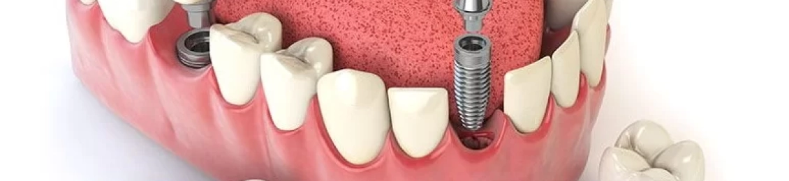 كم تستغرق زراعة الأسنان مع د. محمد بشار