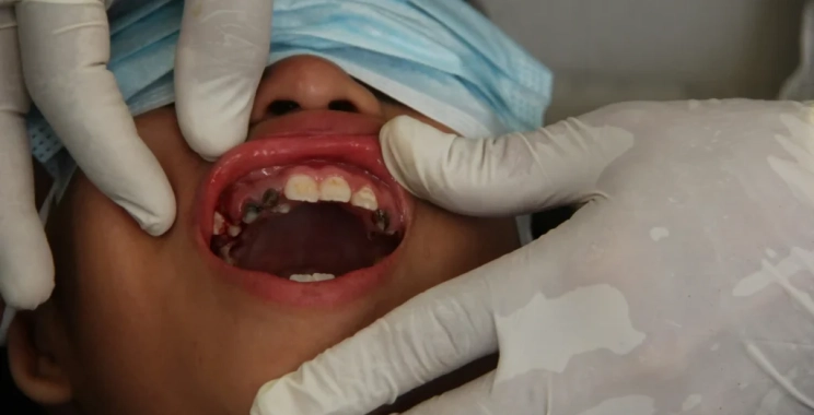 أسباب تسوس الأسنان الدائمه عند الأطفال وكيفية الوقاية منها