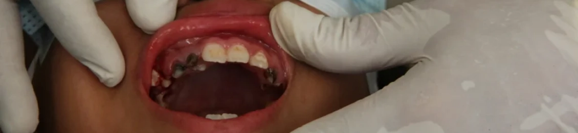 أسباب تسوس الأسنان الدائمه عند الأطفال وكيفية الوقاية منها