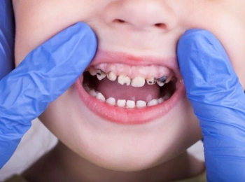طرق علاج تسوس الأسنان عند الأطفال 5 سنوات