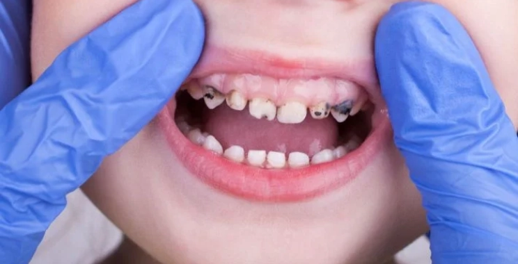 طرق علاج تسوس الأسنان عند الأطفال 5 سنوات