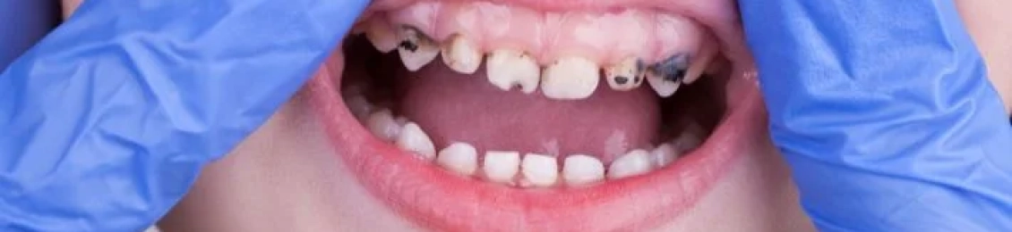 طرق علاج تسوس الأسنان عند الأطفال 5 سنوات