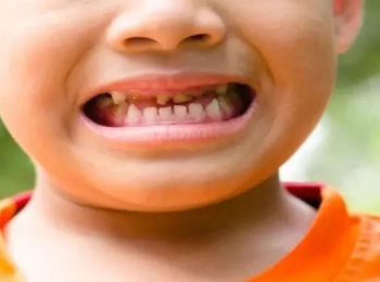 أسباب تسوس الأسنان عند الأطفال رغم تنظيفها وكيفية علاجه