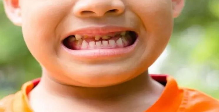 أسباب تسوس الأسنان عند الأطفال رغم تنظيفها وكيفية علاجه