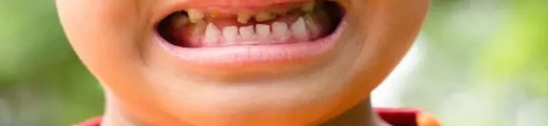 أسباب تسوس الأسنان عند الأطفال رغم تنظيفها وكيفية علاجه