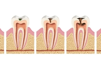 اهم مراحل تسوس الاسنان وعلاجها في المدينة المنورة