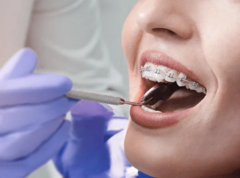 هل تضعف الأسنان بعد التقويم؟ الأسباب والحلول الوقائية