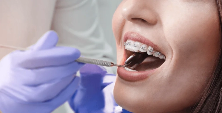 هل تضعف الأسنان بعد التقويم؟ الأسباب والحلول الوقائية