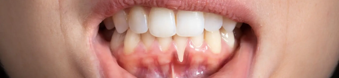 متى تظهر نتائج قص اللثة؟ وأفضل التقنيات في المدينة المنورة