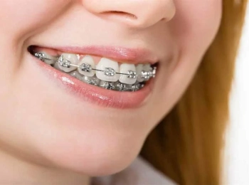 ما هي مدة تقويم الأسنان البارزة من التشخيص حتى العلاج