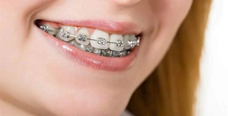 ما هي مدة تقويم الأسنان البارزة من التشخيص حتى العلاج