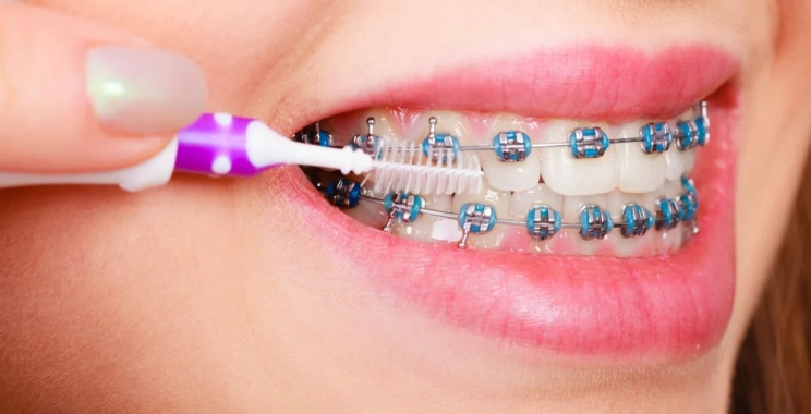 أخطاء تقويم الأسنان الشائعة وطرق تجنبها للحصول على نتائج مثالية