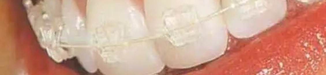 حجز تقويم الأسنان الشفاف بالمدينة المنورة بأحدث التقنيات