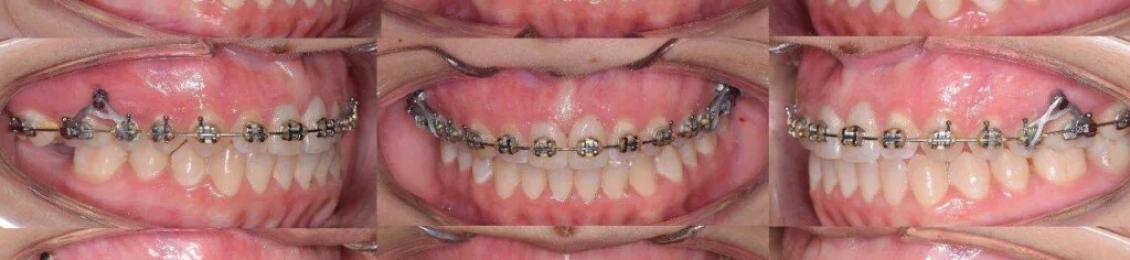 كم تستغرق مدة تقويم الأسنان المعوجة مع افضل الأطباء