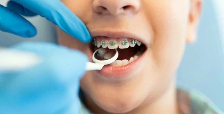 انواع تقويم الأسنان للاطفال: دليل الآباء لاختيار الأفضل