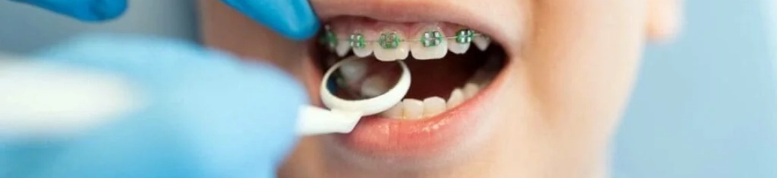 انواع تقويم الأسنان للاطفال: دليل الآباء لاختيار الأفضل