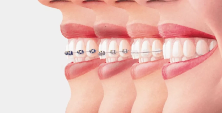 تعرف على مدة تقويم الأسنان للحالات البسيطة