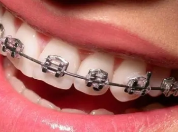 تركيب تقويم الاسنان بالخطوات وشروطه