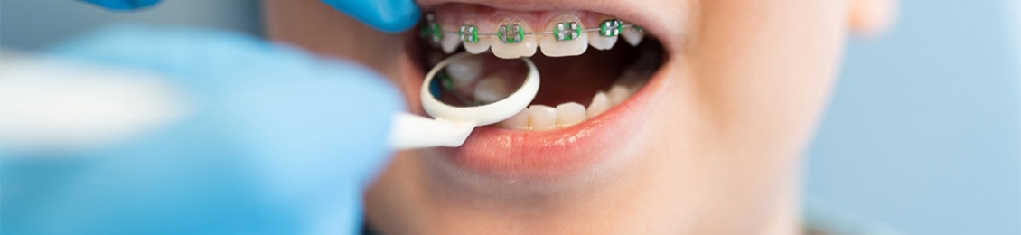 ما هي فوائد تقويم الاسنان للاطفال؟