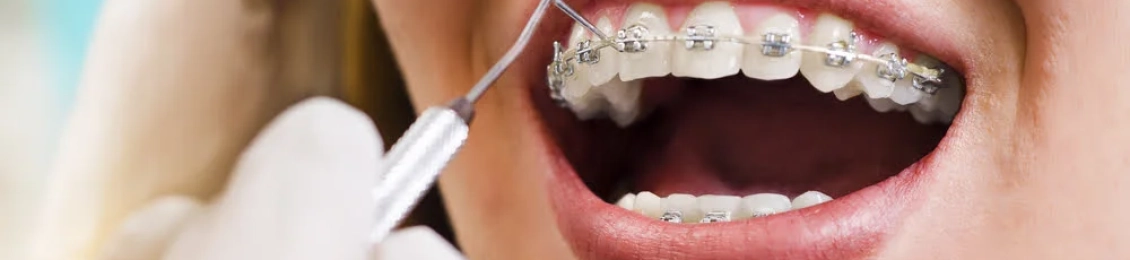 فوائد تقويم الاسنان للفك وتحسين الابتسامة