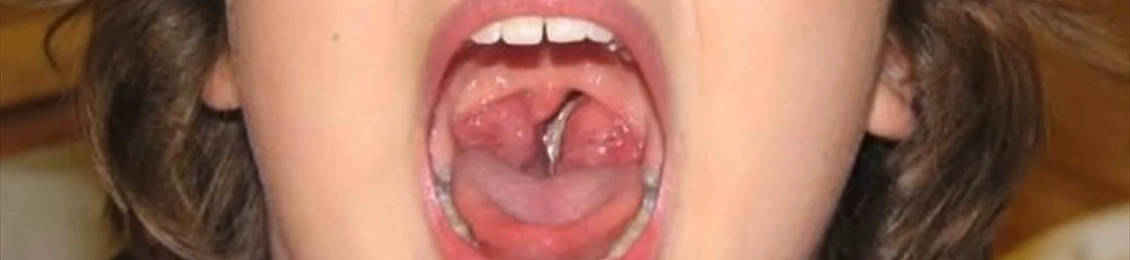 ماذا تكشف مسحة الحلق؟ أهم الأمراض التي يمكن تشخيصها بسهولة