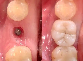 متى تلتئم اللثة بعد زراعة الاسنان؟